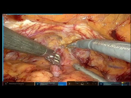 Cas de Prostatectomie Radicale Robotisée avec un Résultat Précoce