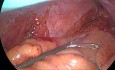 Excision Totale Mésorectale (ETM) par Laparoscopie pour Cancer du Rectum chez un Homme Présentant un Bassin Etroit
