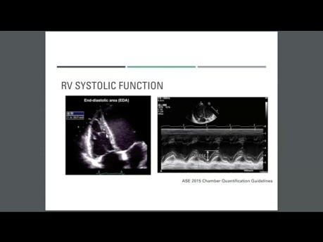 Évaluations Echocardiographiques dans la Cardiomyopathie Dilatée (DCM)