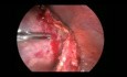 Traitement laparoscopique d'un gros cystadénome et une torsion d'annexe