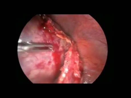 Traitement laparoscopique d'un gros cystadénome et une torsion d'annexe