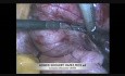 Résection laparoscopique du myome du ligament large