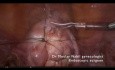 Polymyomectomie laparoscopique ambulatoire