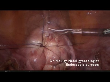 Polymyomectomie laparoscopique ambulatoire