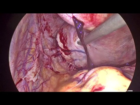 Myomectomie Multiple Laparoscopique