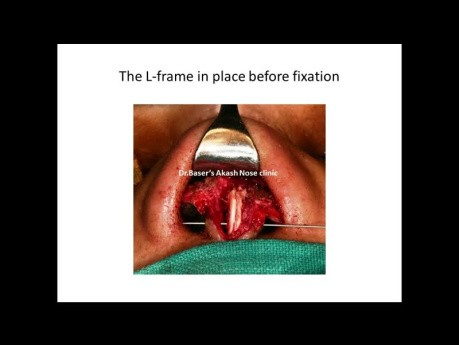 6ème Rhinoplastie de Révision