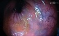 Vue Rétrofléchie du Rectum Humain Normal