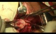 L'hystérectomie vaginale
