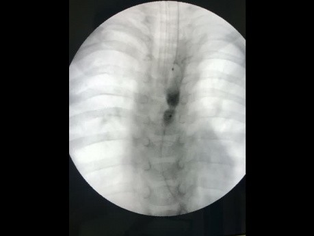 Structure de l'atrésie post-oesophagienne