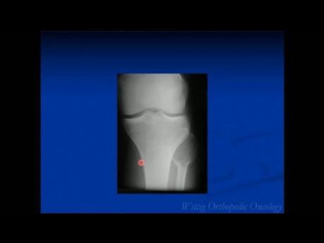 Cours d'oncologie orthopédique - Cas inconnus du test, partie A (cas 1 à 10) - Conférence 11