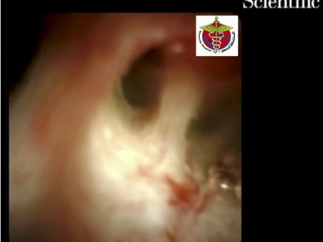 Cholangioscopie Per Orale: Cholangite Sclérosante Primitive 