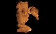 Fente labiale - échographie fœtale en 3D
