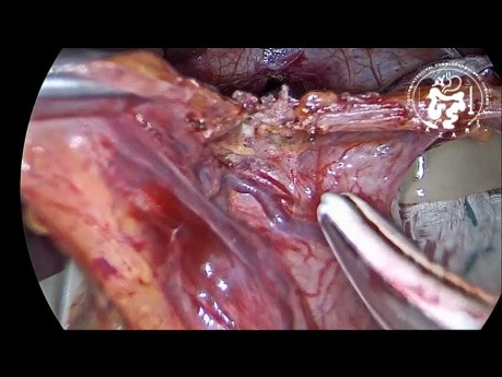 Cardiomyotomie Heller laparoscopique pour l'achalasie