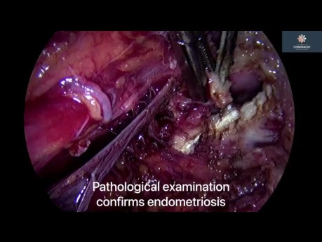 Endométriose à paramètres profonds et maladie péritonéale diffuse - Péritonectomie de la loge postérieure