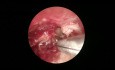 Chirurgie du Cholestéatome: Approche Endoscopique et Microscopique
