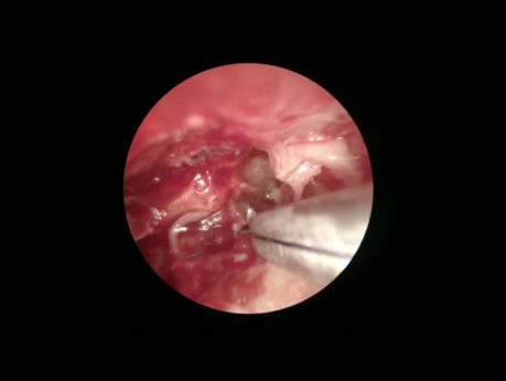 Chirurgie du Cholestéatome: Approche Endoscopique et Microscopique