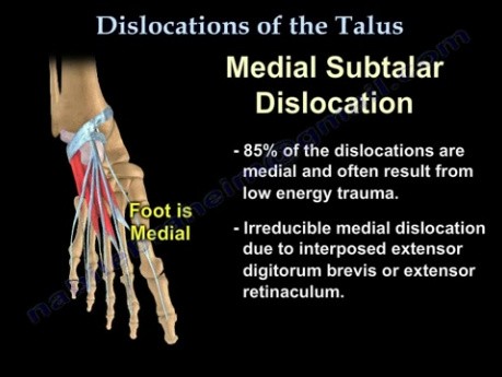 Luxations du talus