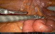 Colectomie Gauche Robotisée pour Diverticulose