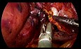 Hémihépatectomie droite par laparoscopie, voie d'abord caudal sans manœuvre de Pringle