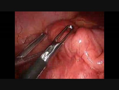 Traitement laparoscopique de l'intussusception intestinale.