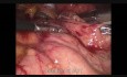 Gastrectomie en manchon par voie laparoscopique en raison de la tumeur stromale