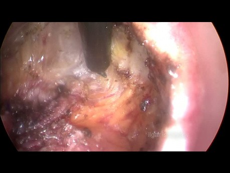 Exérèse totale du mésorectum par voie transanale (TaTME) pour le cancer du bas rectum