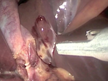 Chirurgie de la vésicule biliaire par technique de l'incision unique