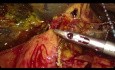 Double bypass par laparoscopie dans le cancer du pancréas non résécable