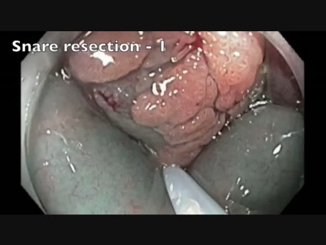 Côlon: Résection Muqueuse Endoscopique compliquée d'une perforation - partie 4
