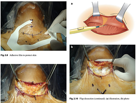 Atlas de la chirurgie thyroïdienne - procédures ouvertes, endoscopiques et robotiques