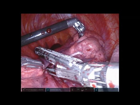 Segmentectomie postérieure assistée par robot - poumon droit