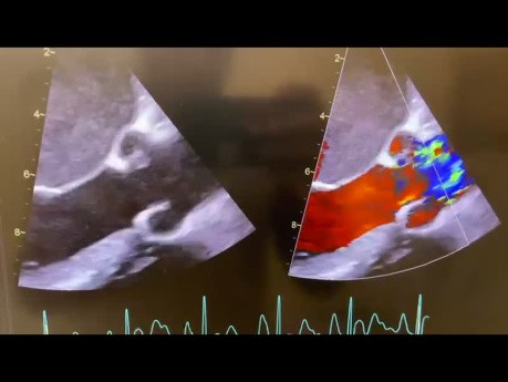 Pouvez-vous deviner le cas échocardiographique suivant?