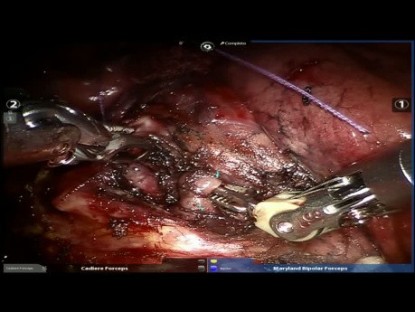 Cancer du poumon - Bilobectomie inférieure robot-assistée après un traitement néoadjuvant