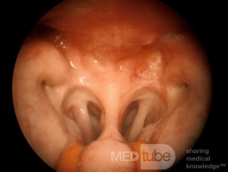 Carcinome du nasopharynx