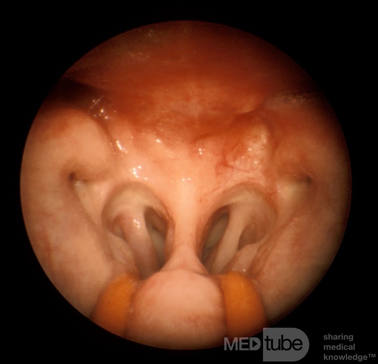 Carcinome du nasopharynx