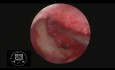 Myringoplastie endoscopique HD