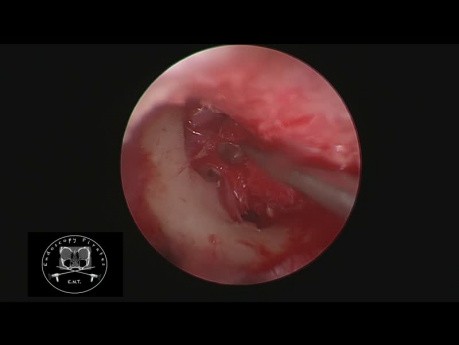 Myringoplastie endoscopique HD