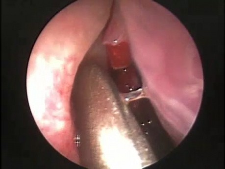 Kyste de cholestérol dans le sinus maxillaires - ablation endoscopique