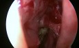 Chirurgie des Sinus - Sinusite Fongique