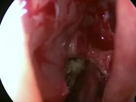 Chirurgie des Sinus - Sinusite Fongique