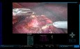 Astuces: Néphrectomie Partielle Robotique avec tumeur 100% Endophytique