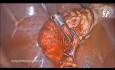 Cholécystectomie Laparoscopique dans la Cholécystite Fibrosante Chronique