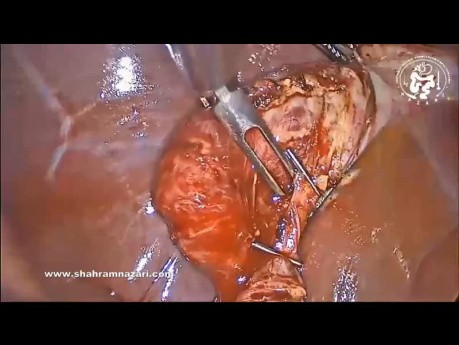 Cholécystectomie Laparoscopique dans la Cholécystite Fibrosante Chronique