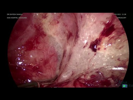 Salpingectomie gauche laparoscopique en raison de l'hydrosalpinx avec libération des adhérences - partie 2
