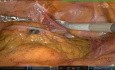 Colectomie Gauche Robotisée pour Cancer de la Jonction Recto-sigmoïdienne