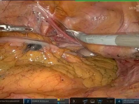 Colectomie Gauche Robotisée pour Cancer de la Jonction Recto-sigmoïdienne