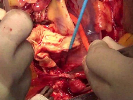 Remplacement total de l'arc aortique avec une trompe d'éléphant stentée