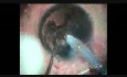 Cataracte sous-capsulaire postérieure avec rupture de la capsule postérieure du cristallin