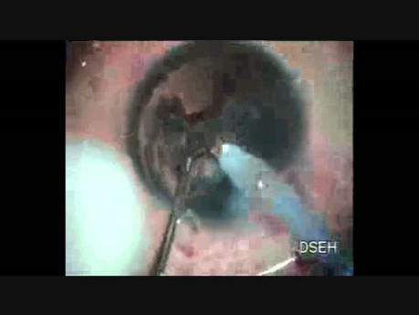 Cataracte sous-capsulaire postérieure avec rupture de la capsule postérieure du cristallin