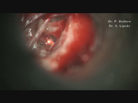 Stapédotomie par laser CO2